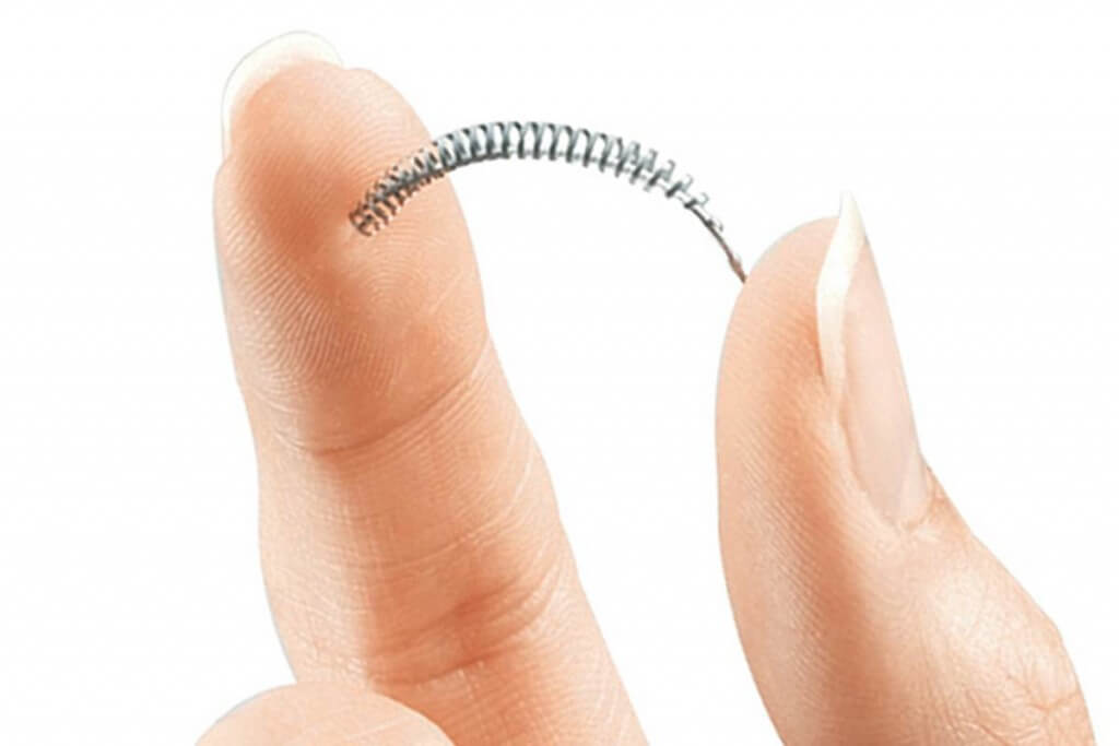 Essure Side Effects