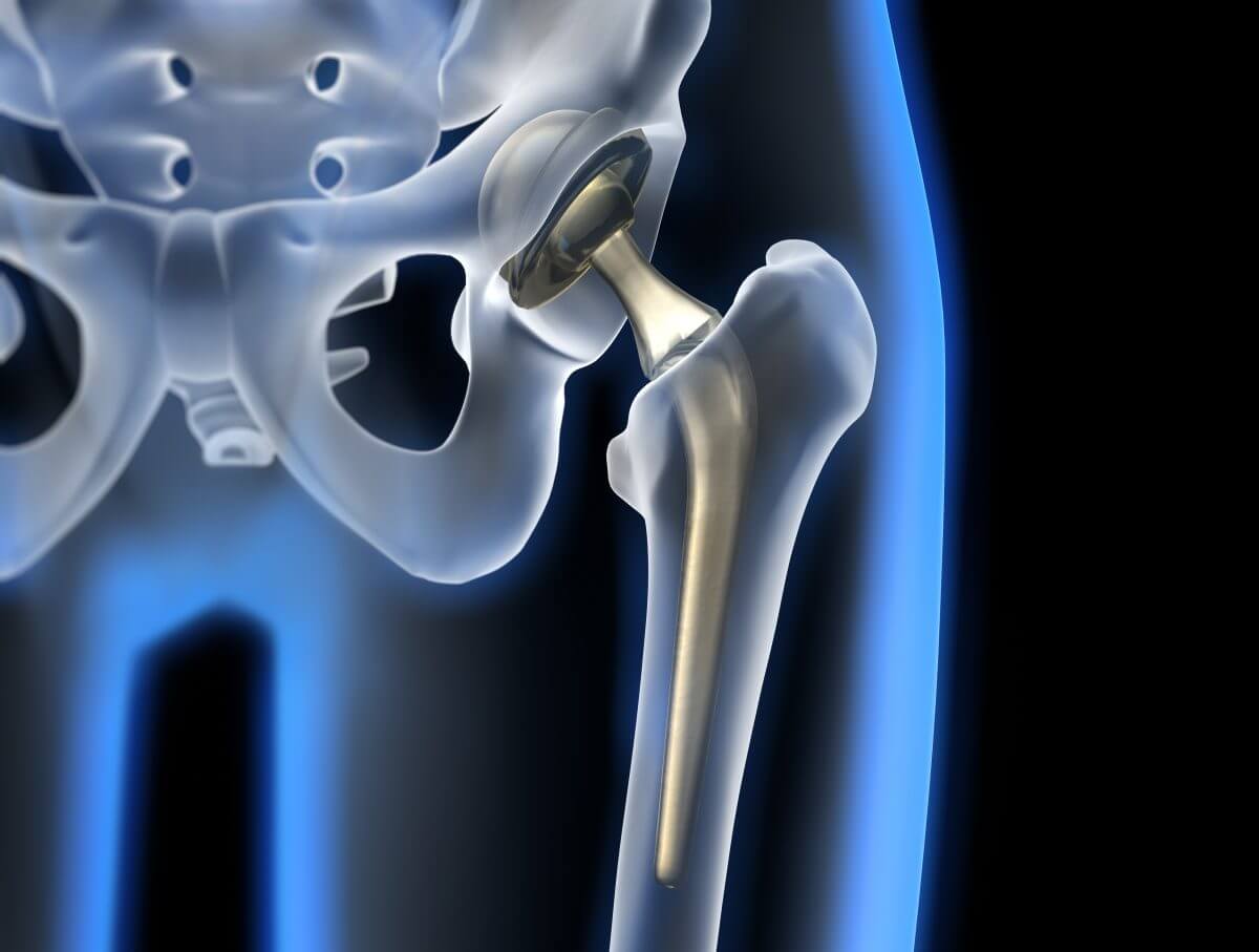 hip implant appeal