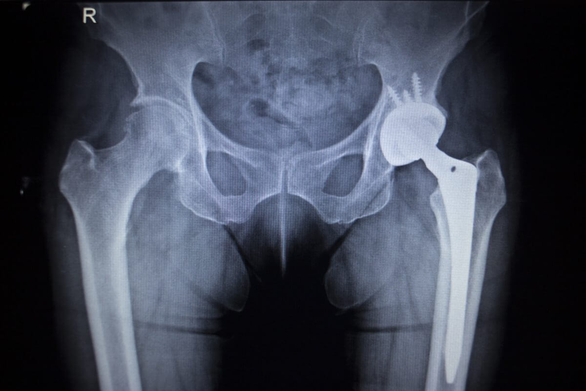 pinnacle hip implant