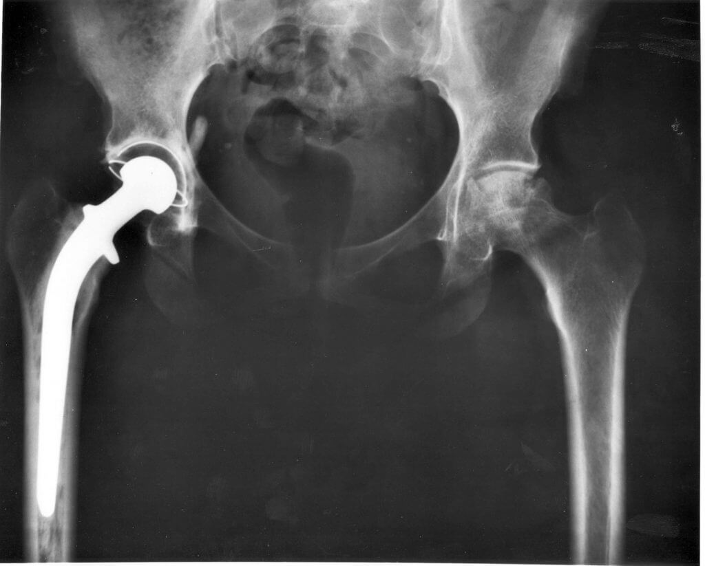 pinnacle hip implant trial