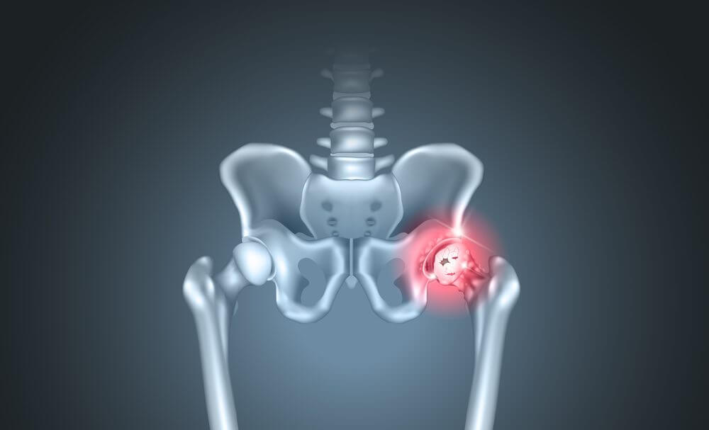 pinnacle hip implant
